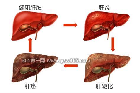 肝癌晚期最怕三个征兆图片,恶心呕吐/食欲不振/腹泻