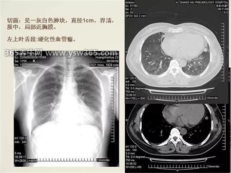 肺部CT检查多少钱一次